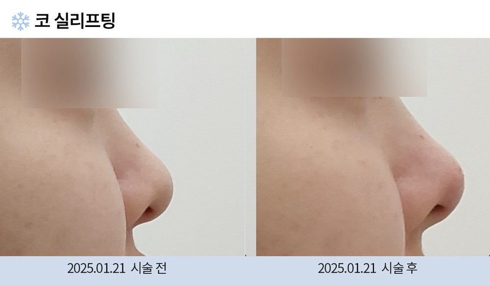 코 실리프팅